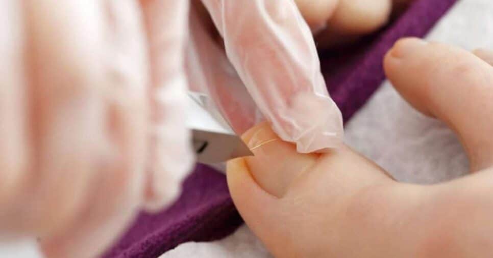 Ilustração unhas encravadas